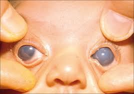  صحة و جمال العيون  - عيون الاطفال - المياه الزرقاء الخلقية